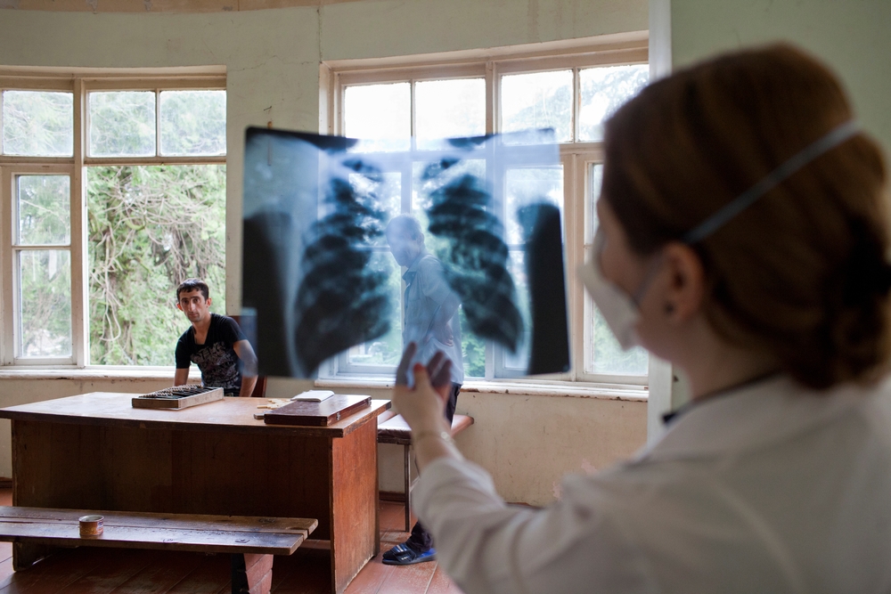 MSF divulga dados preliminares sobre uso de novos medicamentos contra a tuberculose: