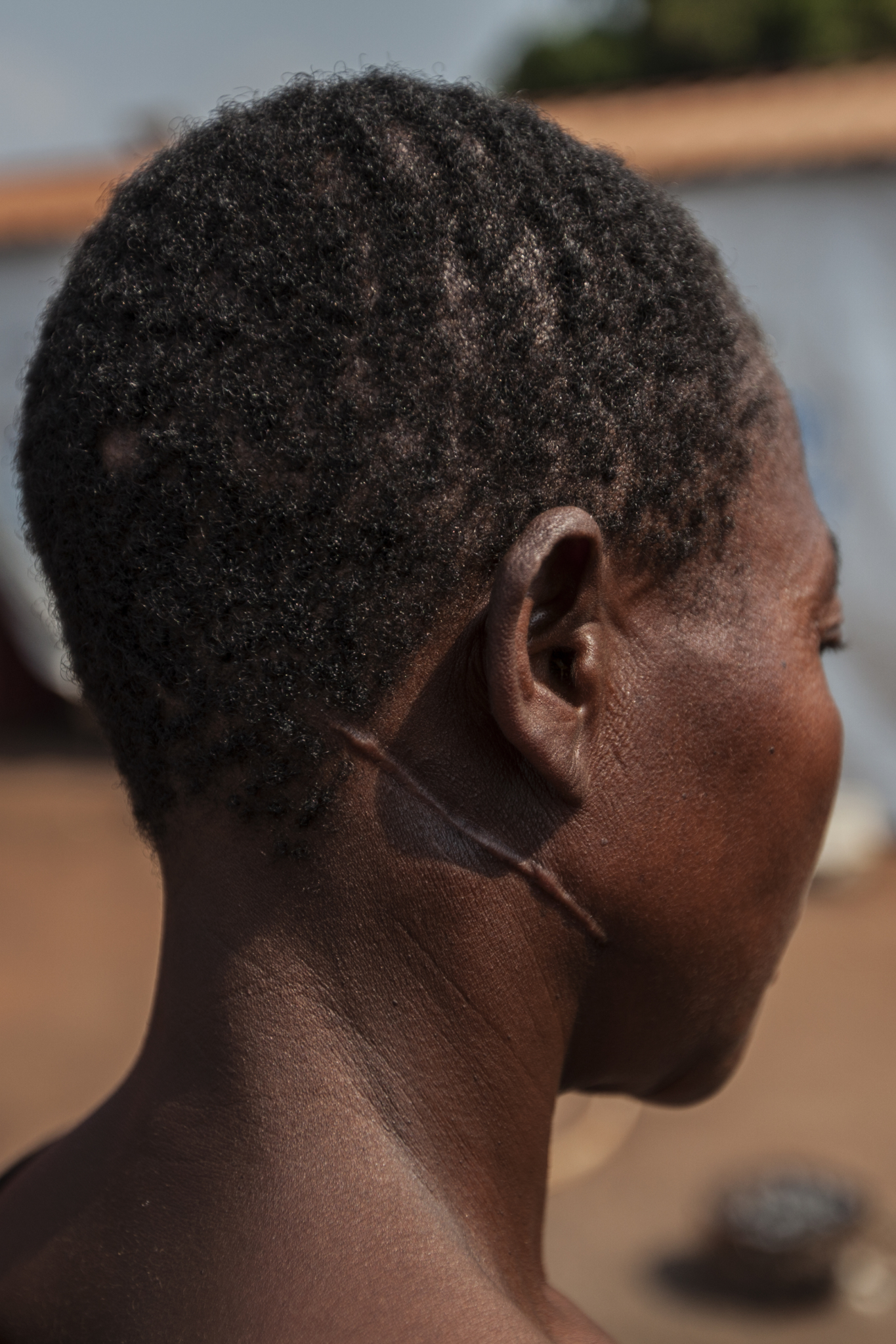Uma refugiada no campo de Kakanda mostra a ferida traumática causada durante o conflito na República Democrática do Congo (RDC). MSF oferece serviços de saúde mental aos refugiados que necessitam, visto que muitos deles foram testemunhas ou vítimas diretas da violência.