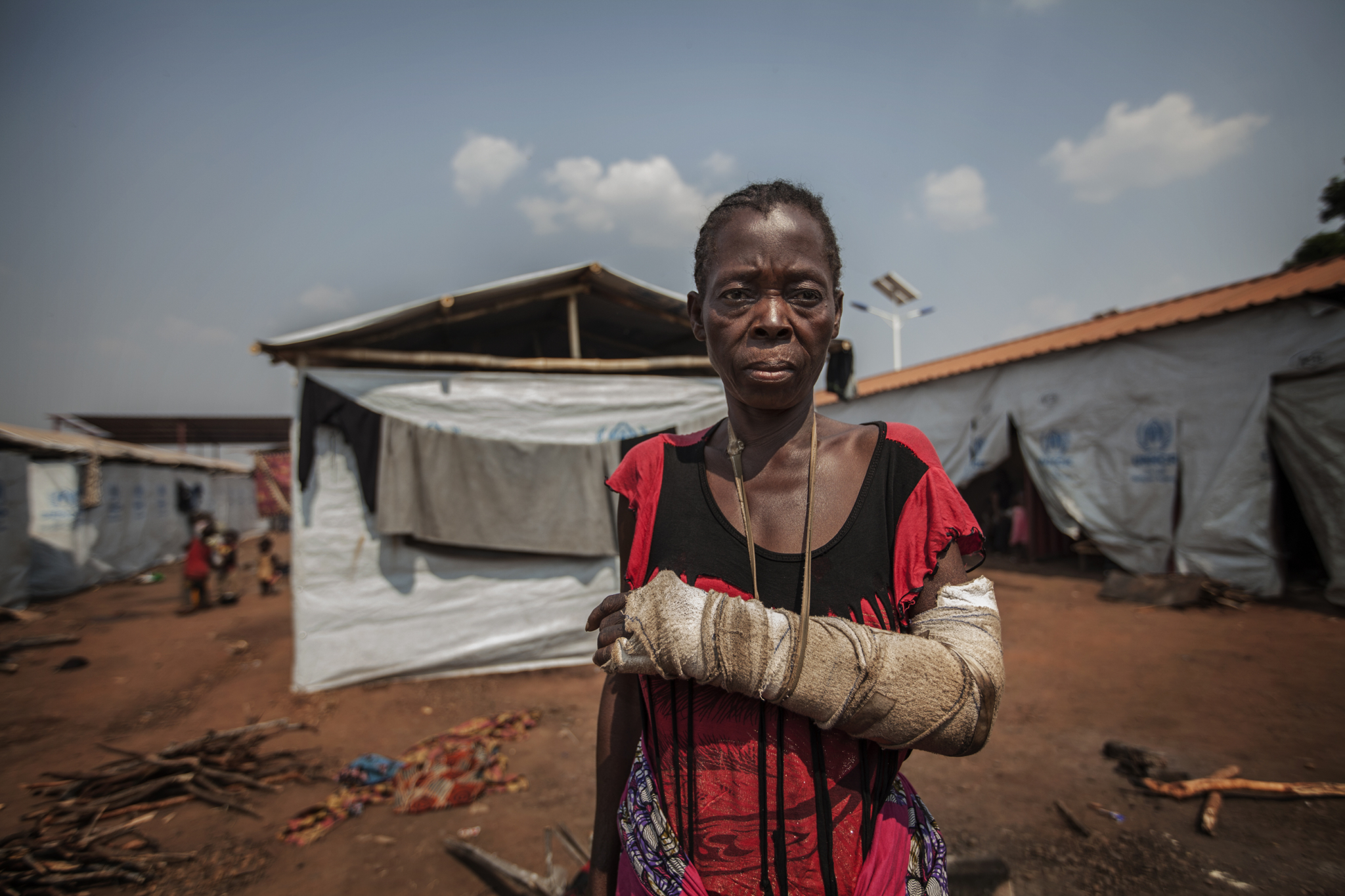 Uma refugiada mostra a cicatriz de uma ferida causada por uma faca num episódio de ataques contra a população civil na província de Kasaï (RDC).