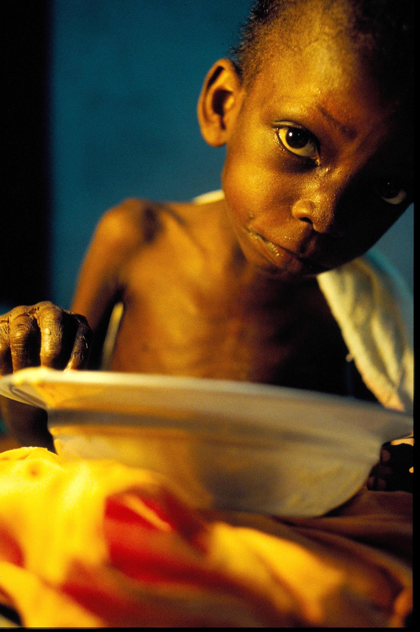Criança com desnutrição severa se alimenta em Tubmanburg. Libéria,1996 (Roger Job)