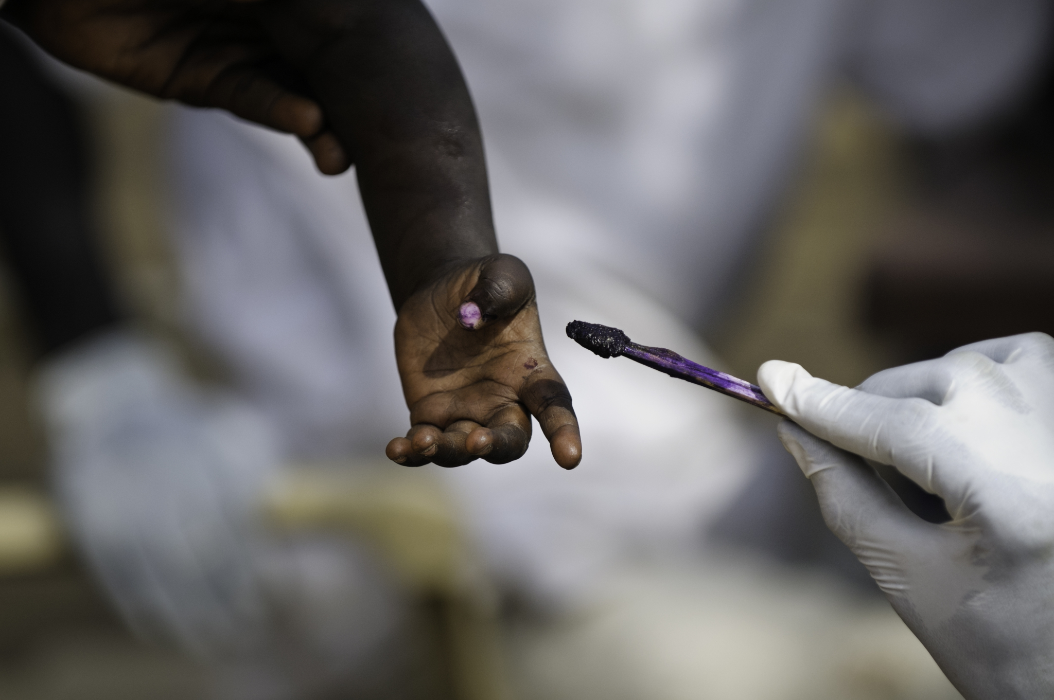 No acampamento de Doro, cerca de 14.500 crianças foram vacinadas contra o sarampo. Depois de vacinadas, as crianças recebem uma marca com tinta para saber que já estão imunizadas.