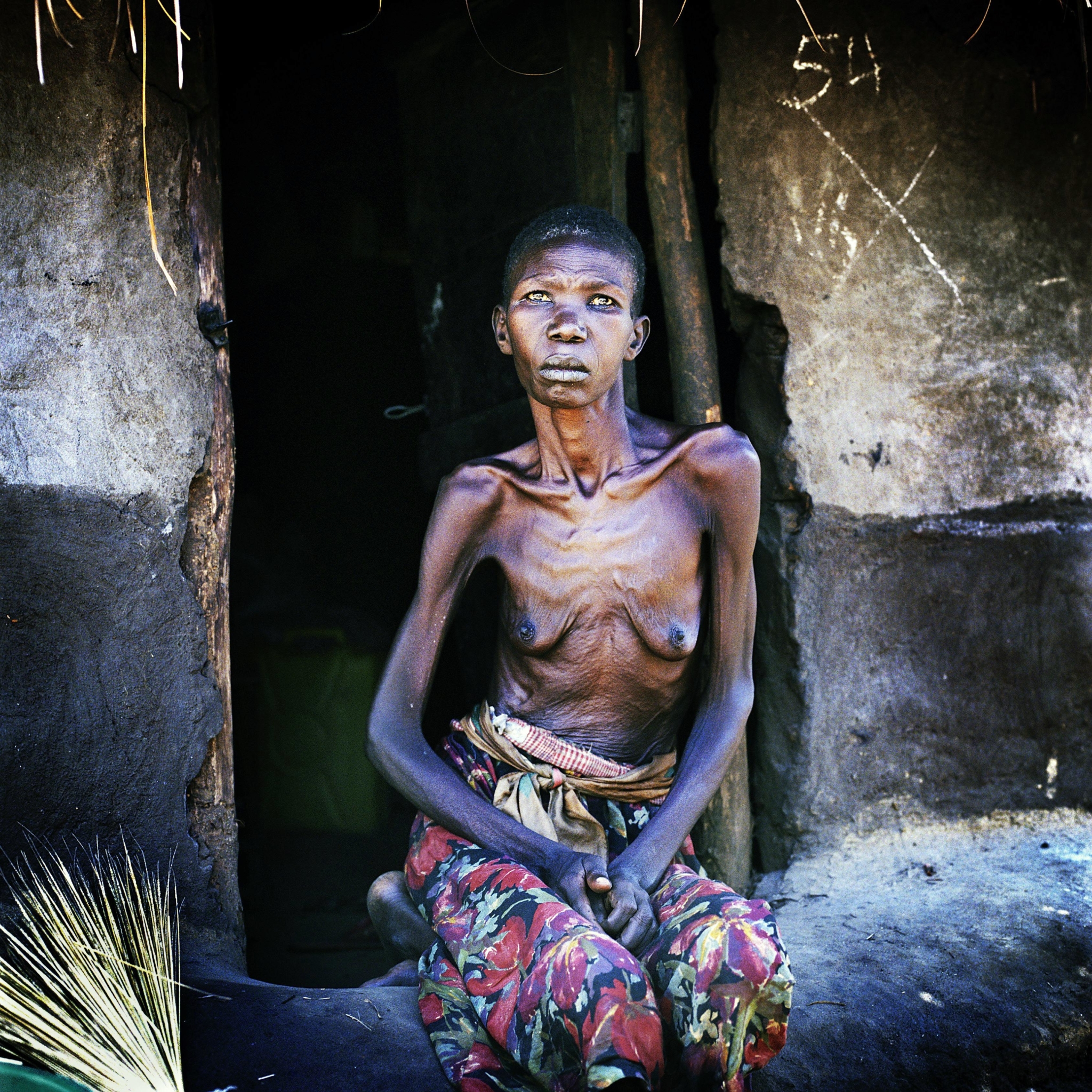 Campo de deslocados de Agweng, norte da Uganda. Keren Aweno, 48 anos, sofre de tuberculose. (Foto: Chris de Bode)