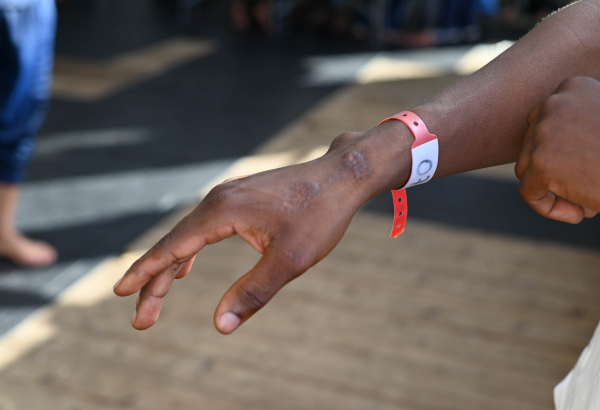 Sobrevivente resgatado no Mar Mediterrâneo mostra cicatriz de agressões que sofreu no período em que foi detido arbitrariamente na Líbia e levado para o deserto. Setembro de 2022. © Candida Lobes/MSF