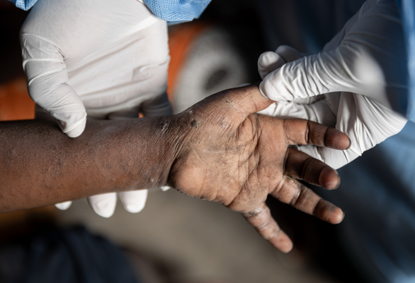 Criança com sinais de mpox em Goma, na República Democrática do Congo. Foto: Michel Lunanga