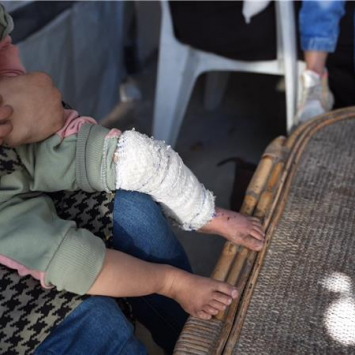 MSF tem testemunhado aumento do número de casos de pacientes com queimaduras em Gaza, a maioria deles crianças.