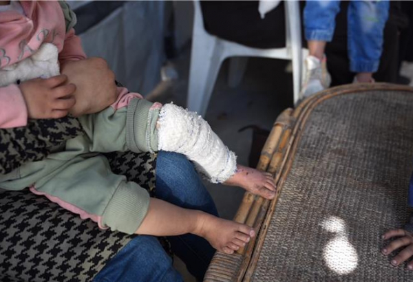 MSF tem testemunhado aumento do número de casos de pacientes com queimaduras em Gaza, a maioria deles crianças.