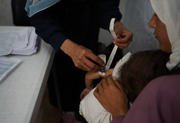 Uma criança palestina que sofre de desnutrição é submetida a um exame médico na clínica da MSF na Cidade de Gaza. ©Nour Alsaqqa/MSF