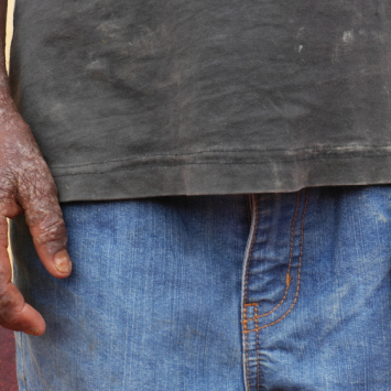 Foto: Mack Alix Mushitsi/MSF