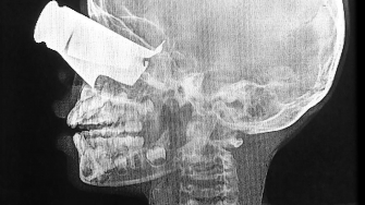 Paciente de 9 anos ferido em ataque com drones no Sudão. Ele foi atendido no hospital em Tine, no Chade, apoiado por MSF. ©MSF