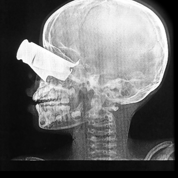 Paciente de 9 anos de idade ferido em ataque condrones no oeste do Sudão. Ele foi atendido no hospital em Tine, no Chade, apoiado por MSF. ©MSF