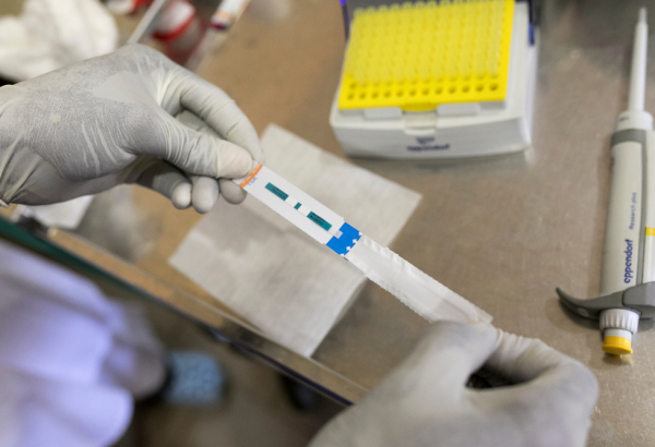 Tuberculose: novos testes e medicamentos seguem fora do alcance de muitos pacientes