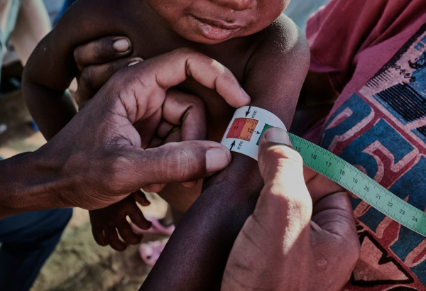 A desnutrição ameaça a população de algumas regiões de Madagascar