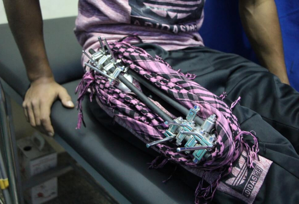 Lesões em Gaza ameaçam deixar vidas permanentemente destruídas